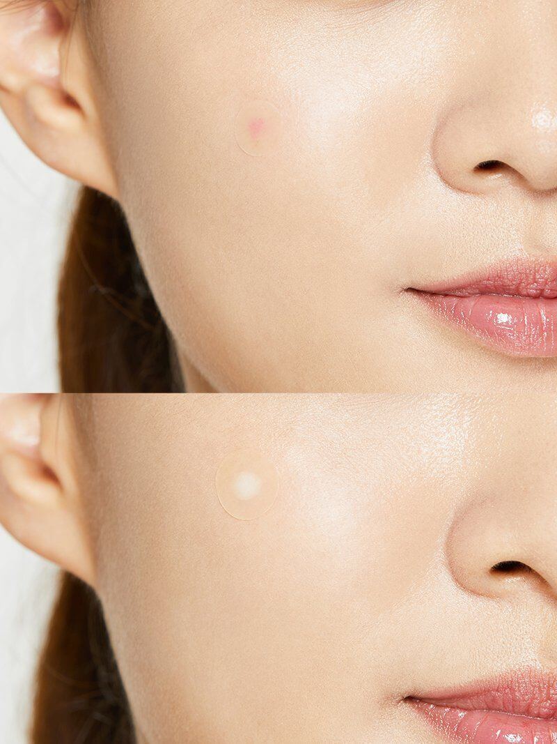 Acne Pimple Master Patch