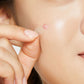 Acne Pimple Master Patch